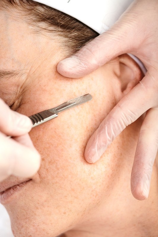 Dermaplaning
